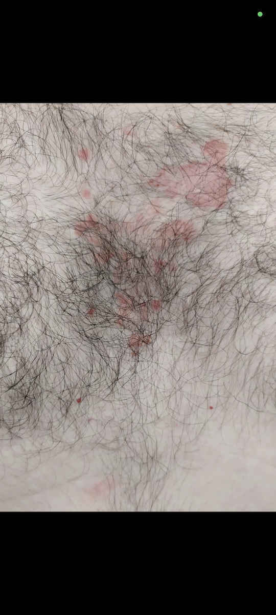 Boderm Bionatar Σαμπουάν κατά της Πιτυρίδας