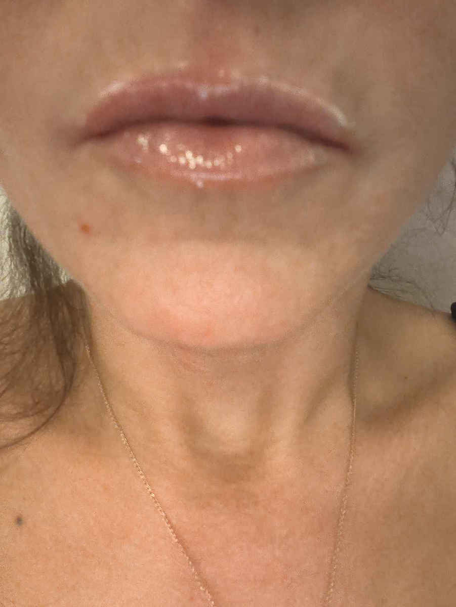 Revox Hyaluronic Acid Lip Filler Крем за устни Hyaluronic Acid 12мл