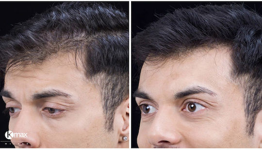 Kmax Milano Hair Thinning Coverage Fibers with Keratin Travel 5gr