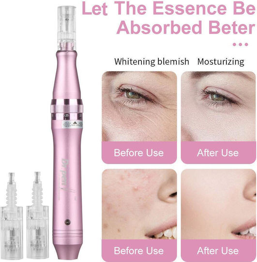 Συσκευή Microneedling για Αντιγήρανση 86942