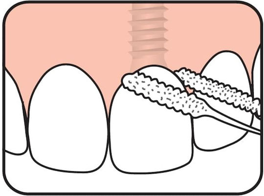 Te Pe Bridge Implant Floss Νήμα Καθαρισμού Γεφυρών & Εμφυτευμάτων 30 Τεμάχια