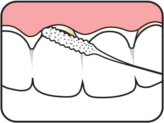 Te Pe Bridge Implant Floss Νήμα Καθαρισμού Γεφυρών & Εμφυτευμάτων 30 Τεμάχια