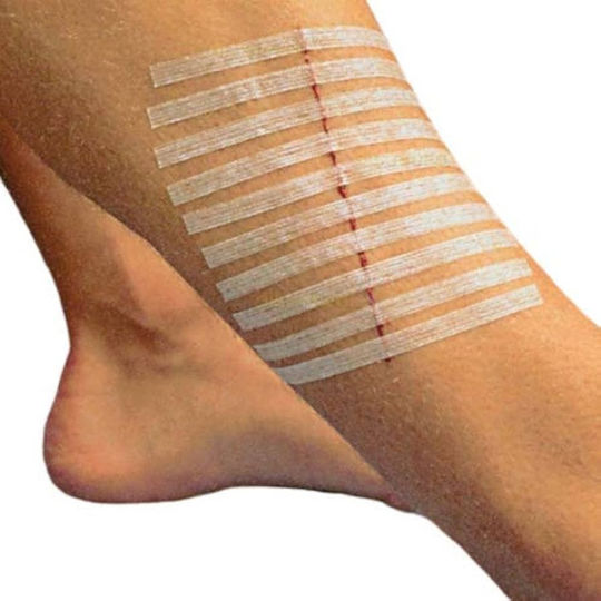 Rudastrip Wound Suture Strips 13mm X 100mm 1 Envelope 6 Strips