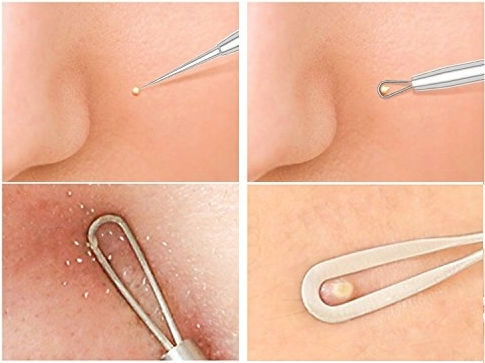 7 Instruments Kit Zola Stainless Steel Cosmetics Blackhead Blackhead Extraction Black
