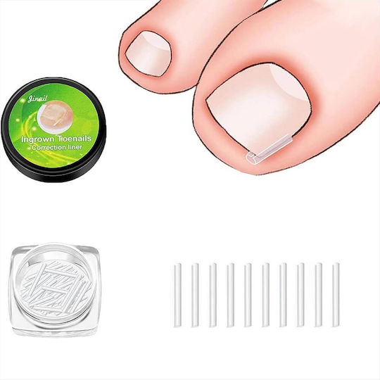 Ingrown Toenail Correction Liner Splint