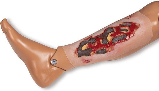 Large Arterial Ulcer Wound of the Foot Exudation Phase Erler Zimmer