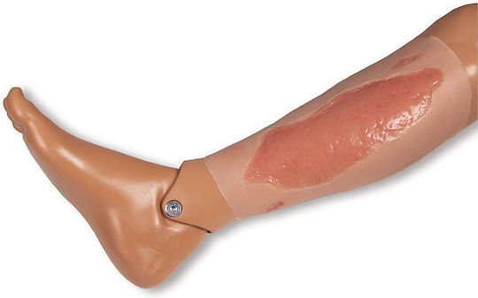 Large Arterial Ulcer Foot Wound Epithelium Phase Erler Zimmer