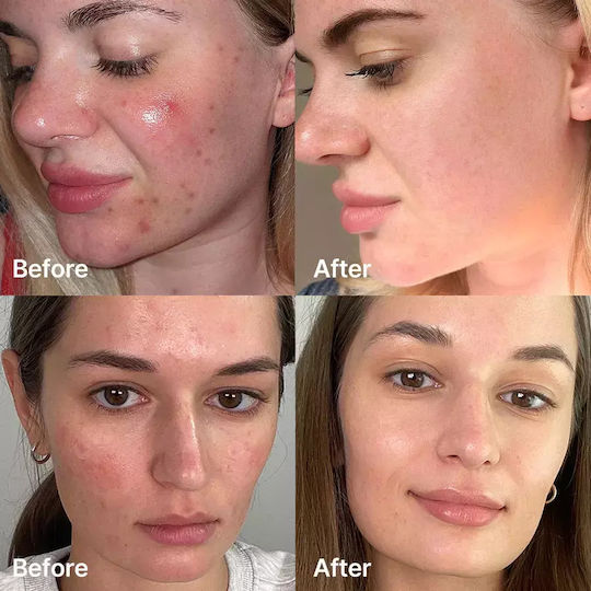 Medicube Red Acne Succinic Acid Peel Серум За лице 40гр