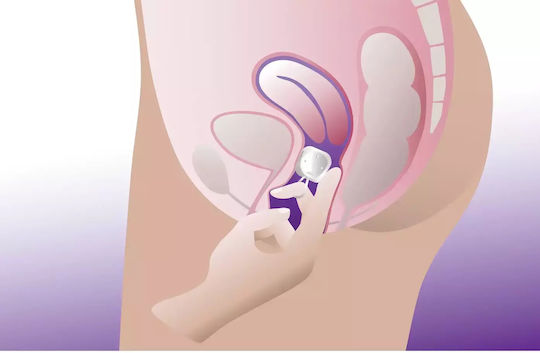 ProFem Vaginal-Pessar Cube Pessary ohne Οπές Ohne Löcher