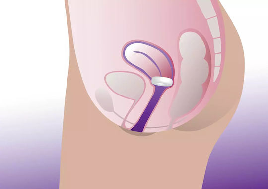 ProFem Donut Vaginal-Pessar 76mm 76mm