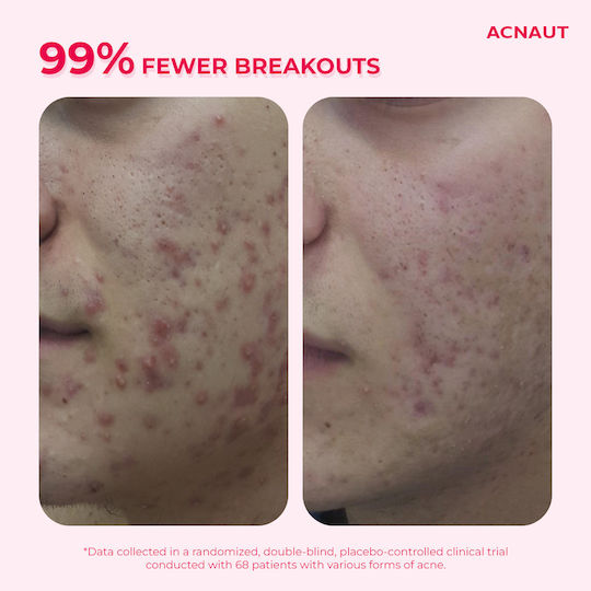 Biotrade Acne Out Λοσιόν για Ακμή & Ερεθισμούς 60ml