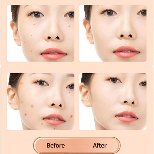 Συσκευή Microneedling για Καθαρισμό από Μαύρα Στίγματα MYD16
