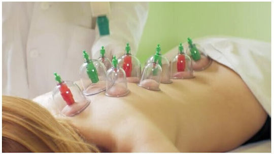 Set of 18 Traditional Therapy Suction Cups