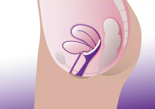 ProFem Ring Pessary Κολπικός Πεσσός