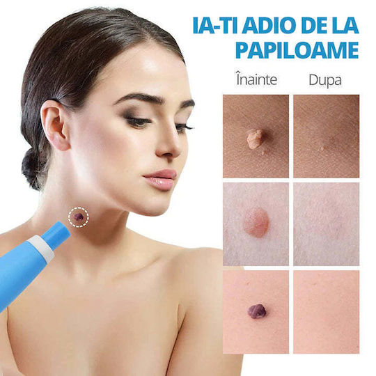 Littledomi Skin Tag Removal Device Kit Face Neck Body 2-8 Mm