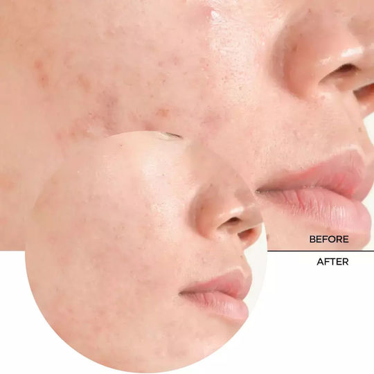 Revox Nur Salicylsäure 2% Serum Gesicht mit Salicylsäure für Entgiftung & Akne 30ml