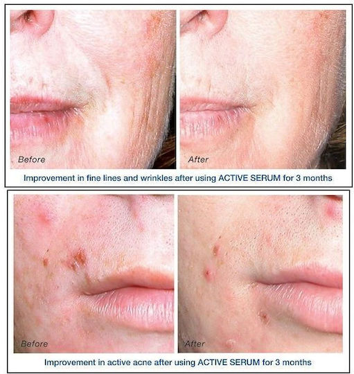 IS Clinical Serum Activ Anti-îmbătrânire pentru Față pentru Strălucire & Acnee 15ml
