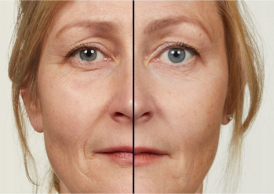 L'Oreal Paris Revitalift Laser Night Anti-aging Serum Face with Retinol & Hyaluronic Acid for Radiance & Firming 30ml