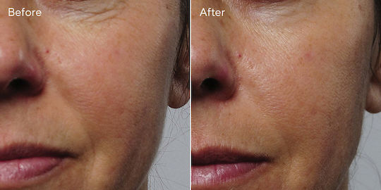 Murad Resurgence Rapid Ενυδατικό & Αντιγηραντικό Serum Προσώπου με Κολλαγόνο για Σύσφιξη & Αναζωογόνηση 30ml