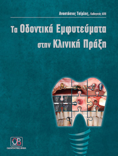 Τα οδοντικά εμφυτεύματα στην κλινική πράξη