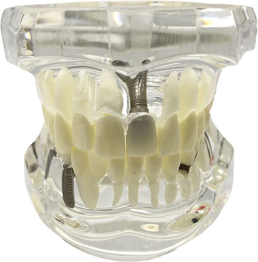 Dental Demonstration Model Ubx Mobilizable Teeth Implants Restorations Dental Pathologi